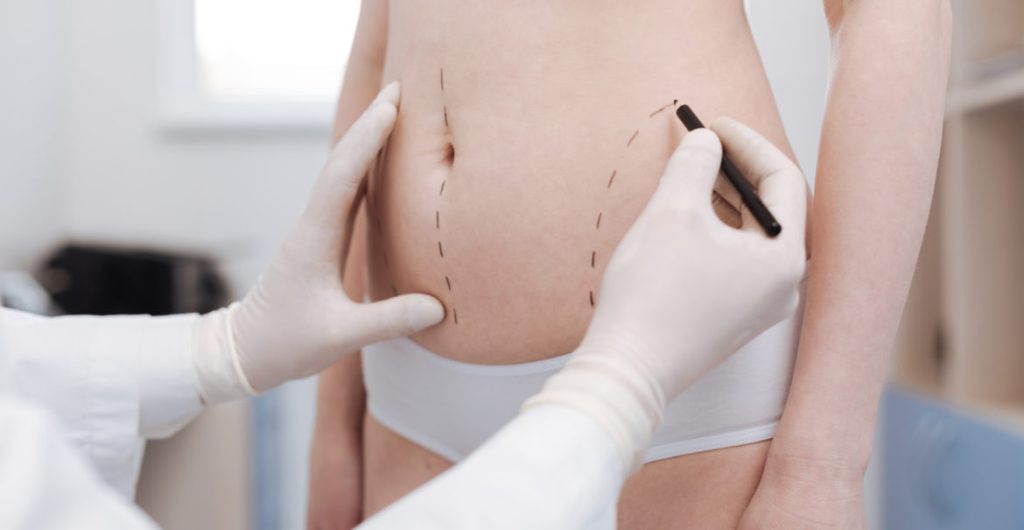 How to Choose a Skilled 360 Lipo Specialist in Miami